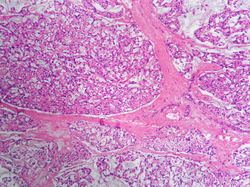 Myoepithelioma Histopathologyguru