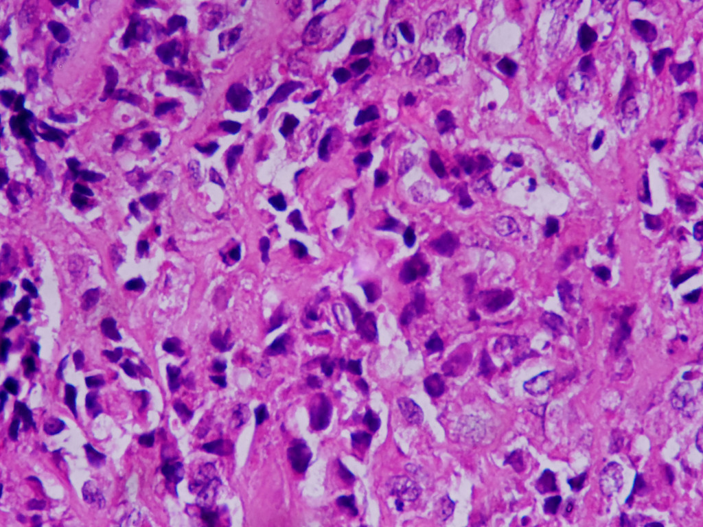 OSTEOSARCOMA Histopathology Guru