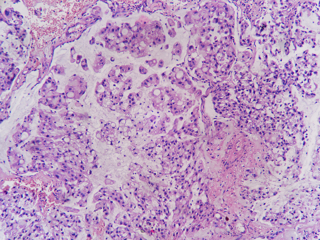 Mucinous Adenocarcinoma Of Cervix – Histopathology.guru