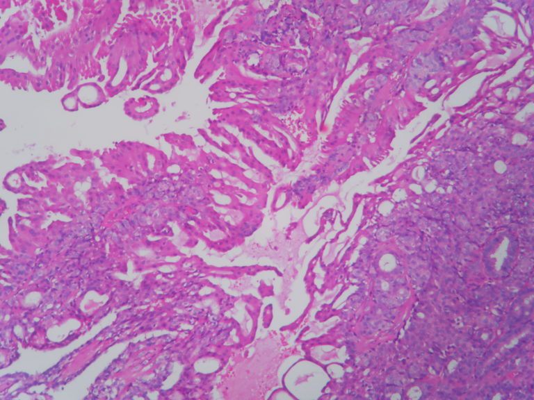 Tubular Adenoma Histopathology Guru