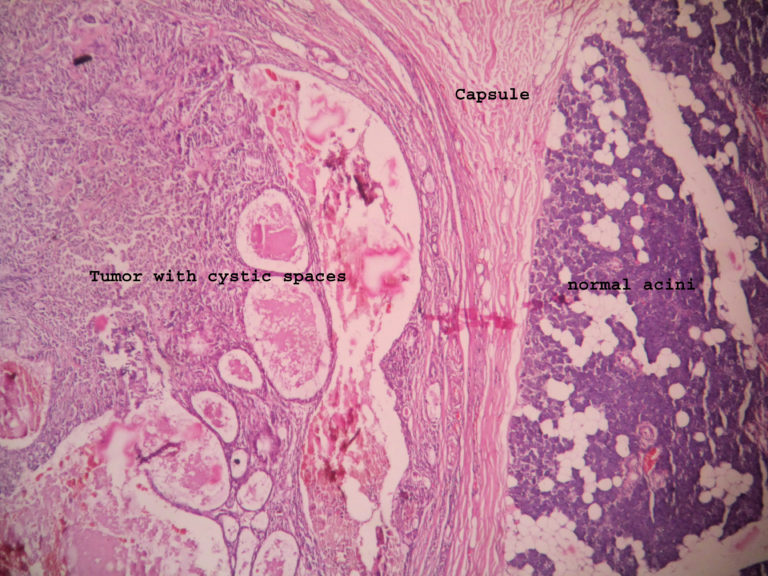 Pleomorphic Adenoma Histopathology Guru