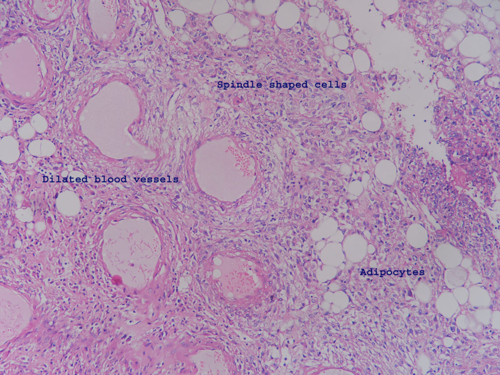 Kidney – Angiomyolipoma – Histopathology.guru