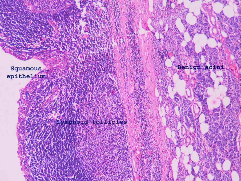 Lymphoepithelial Cyst Of Parotid Histopathology Guru