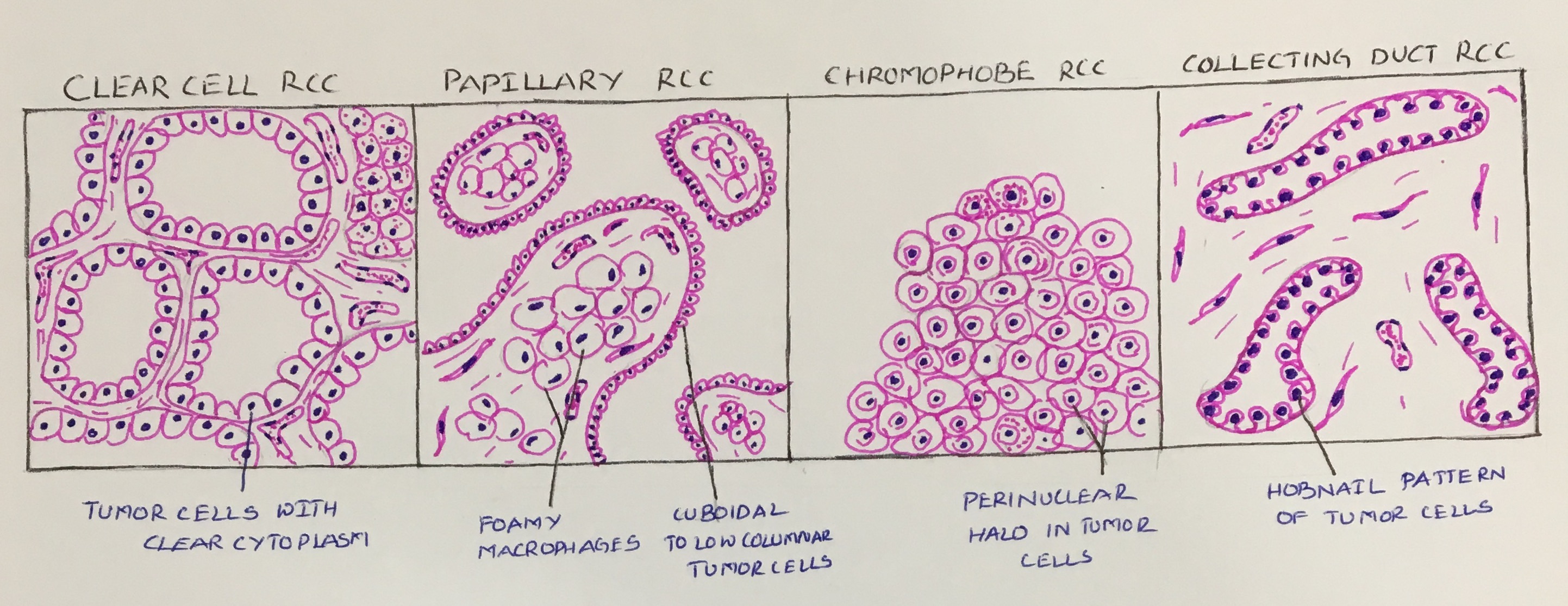 renal-cell-carcinoma-histopathology-guru