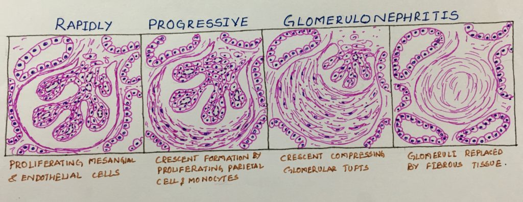 rpgn-and-structureof-the-crescent-histopathology-guru