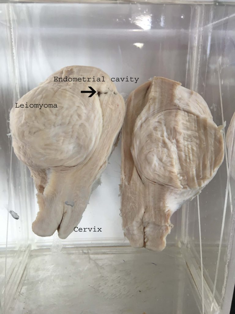 Intramural Leiomyoma Of Uterus Gross Histopathology Guru