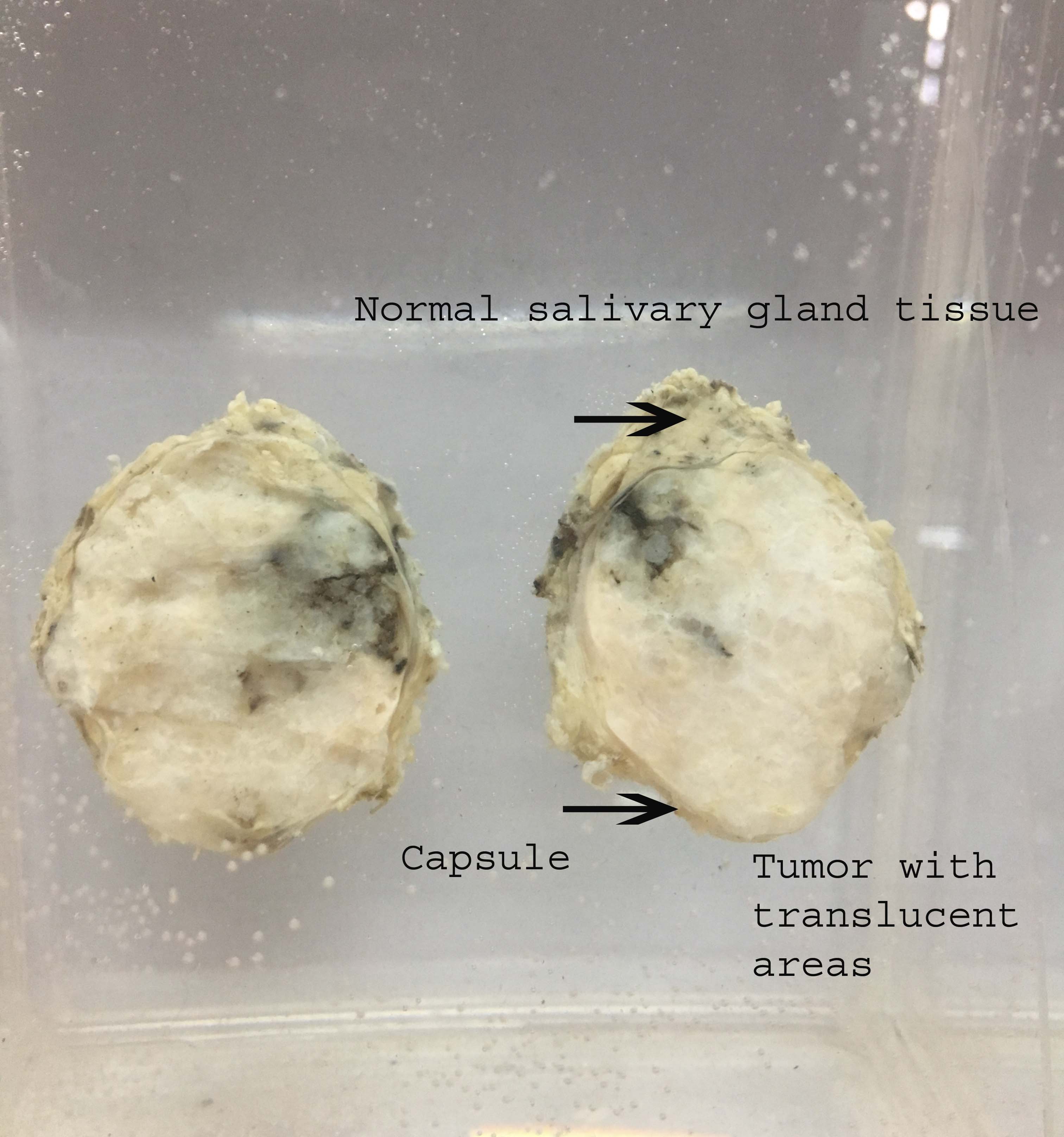 Pleomorphic Adenoma Gross Histopathology Guru