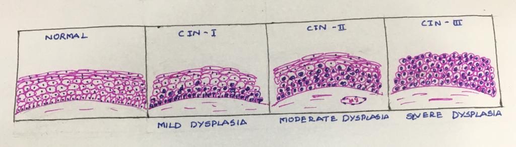 Cervical Intraepithelial Neoplasia Histopathology guru