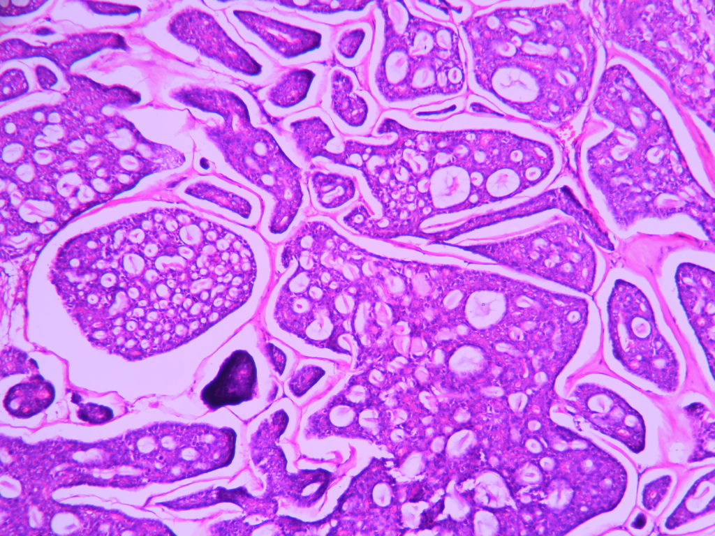 Adenoid Cystic Carcinoma Histopathologyguru 