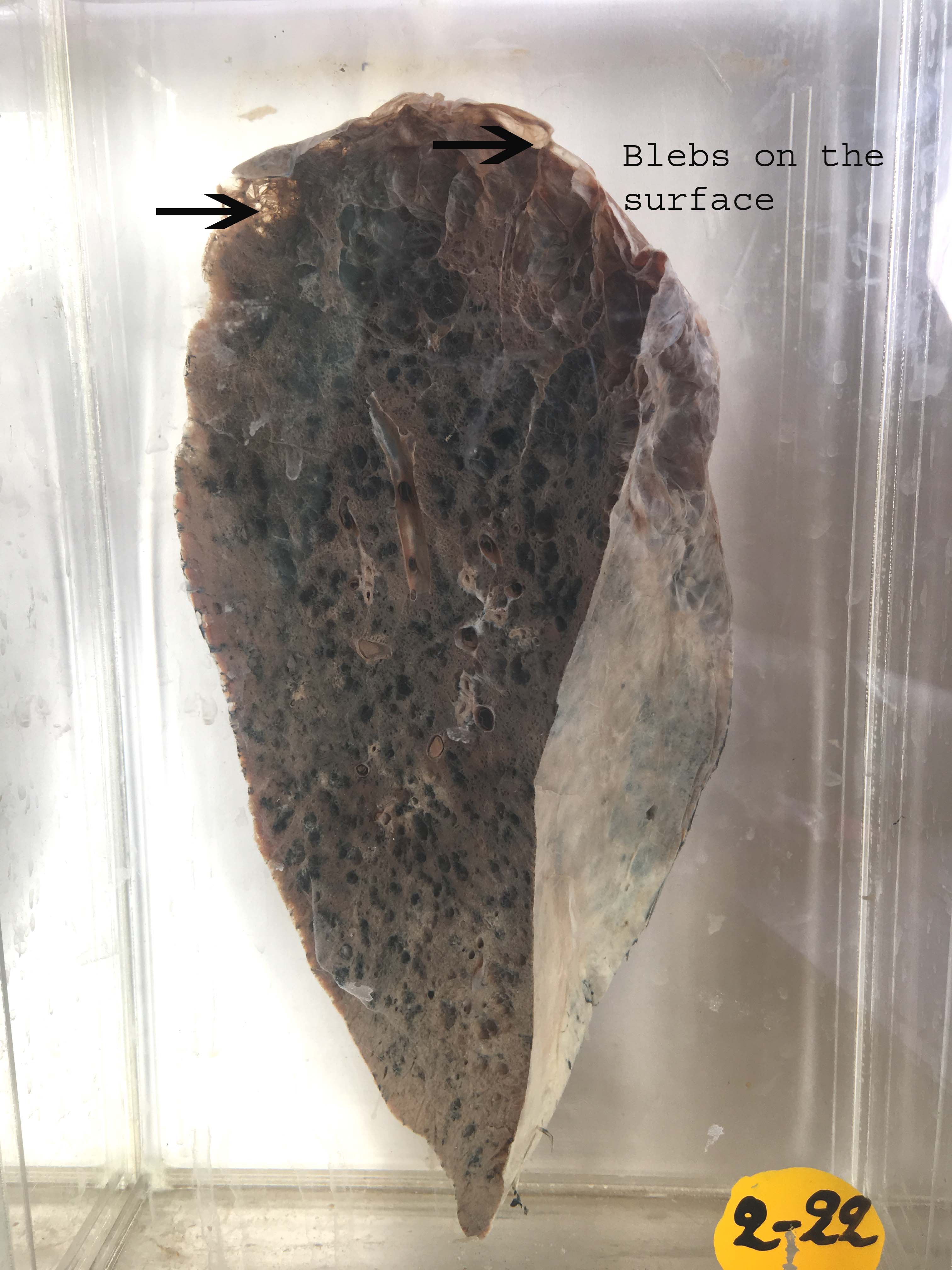 Emphysema Lung Gross Histopathology Guru