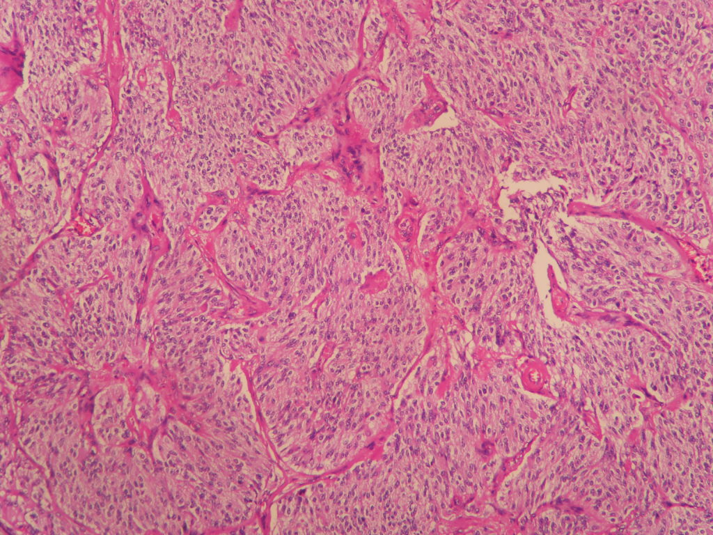 Medullary Carcinoma Thyroid Histopathology Guru