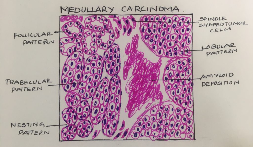 medullary-carcinoma-thyroid-ug-histopathology-guru