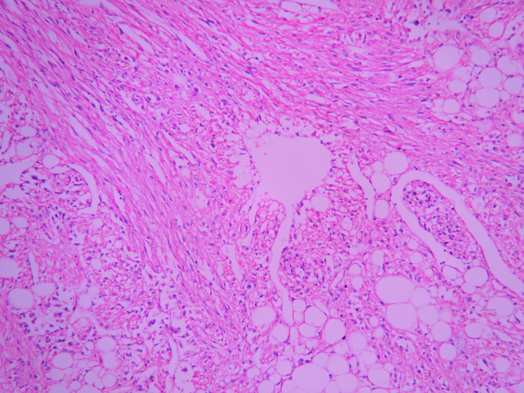 Kidney – Angiomyolipoma – Histopathology.guru