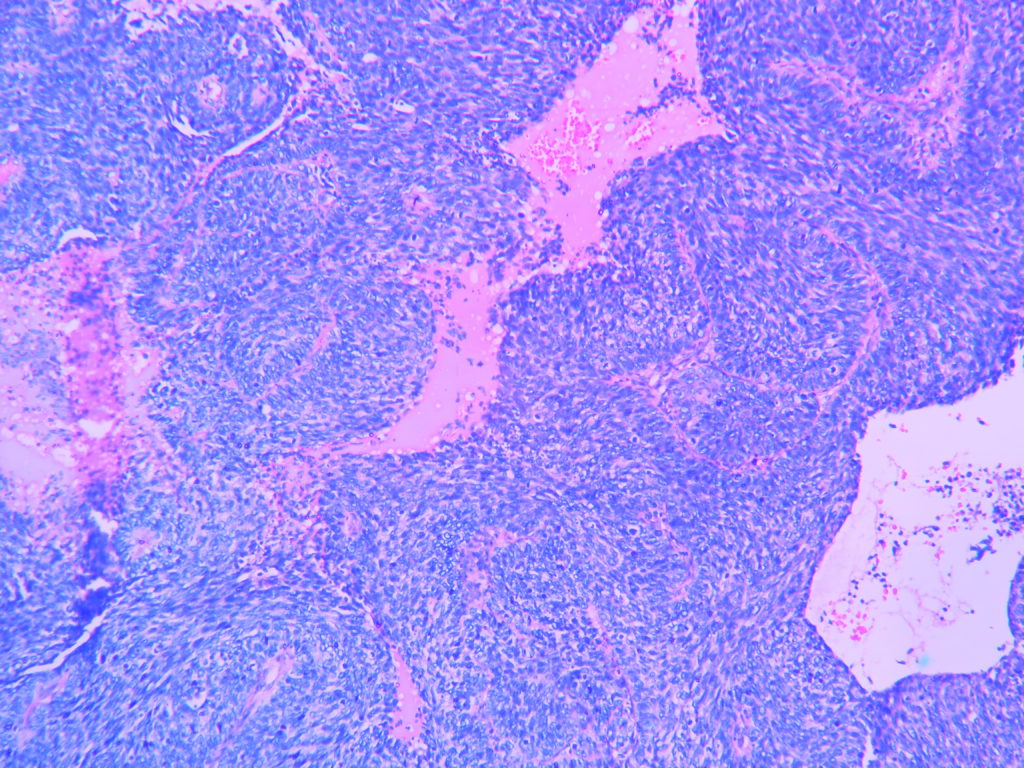 BASALOID SQUAMOUS CELL CARCINOMA – Histopathology.guru