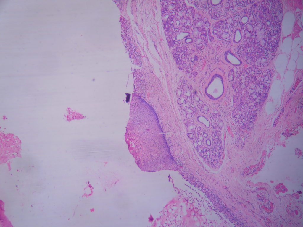 Mucinous Retention Cyst Of Parotid Histopathology Guru