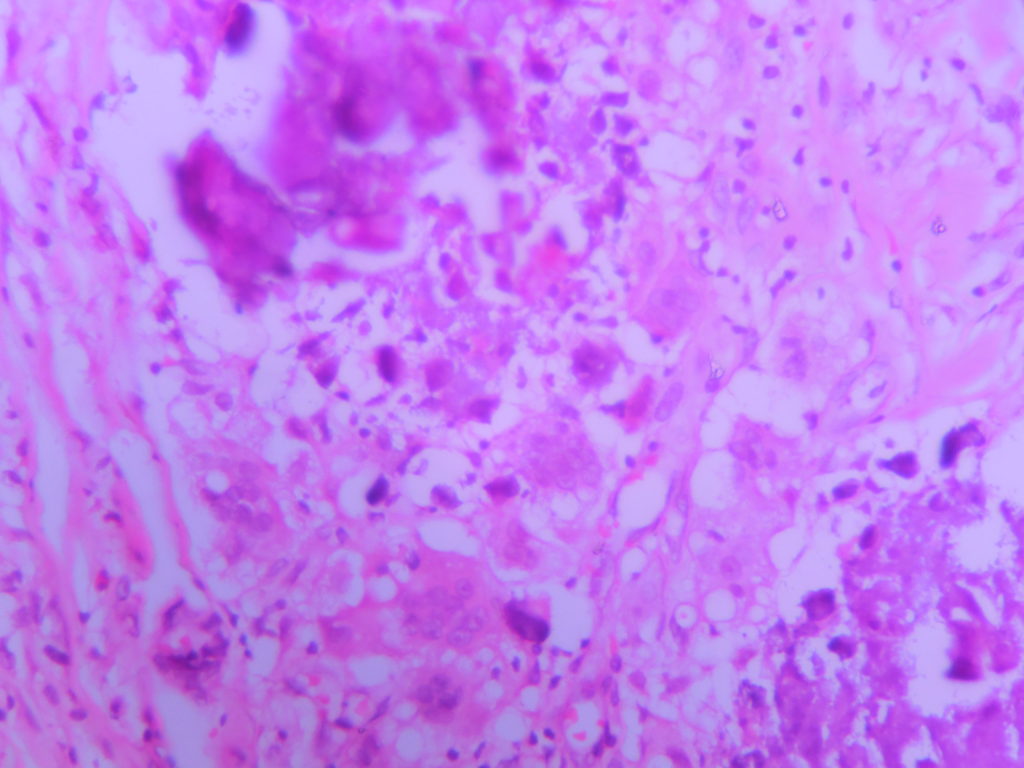 Calcinosis Cutis – Histopathology.guru