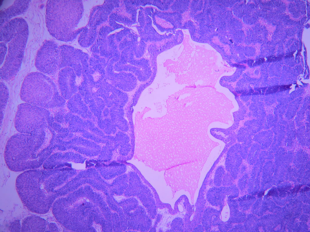 Inverted Papilloma Histopathologyguru