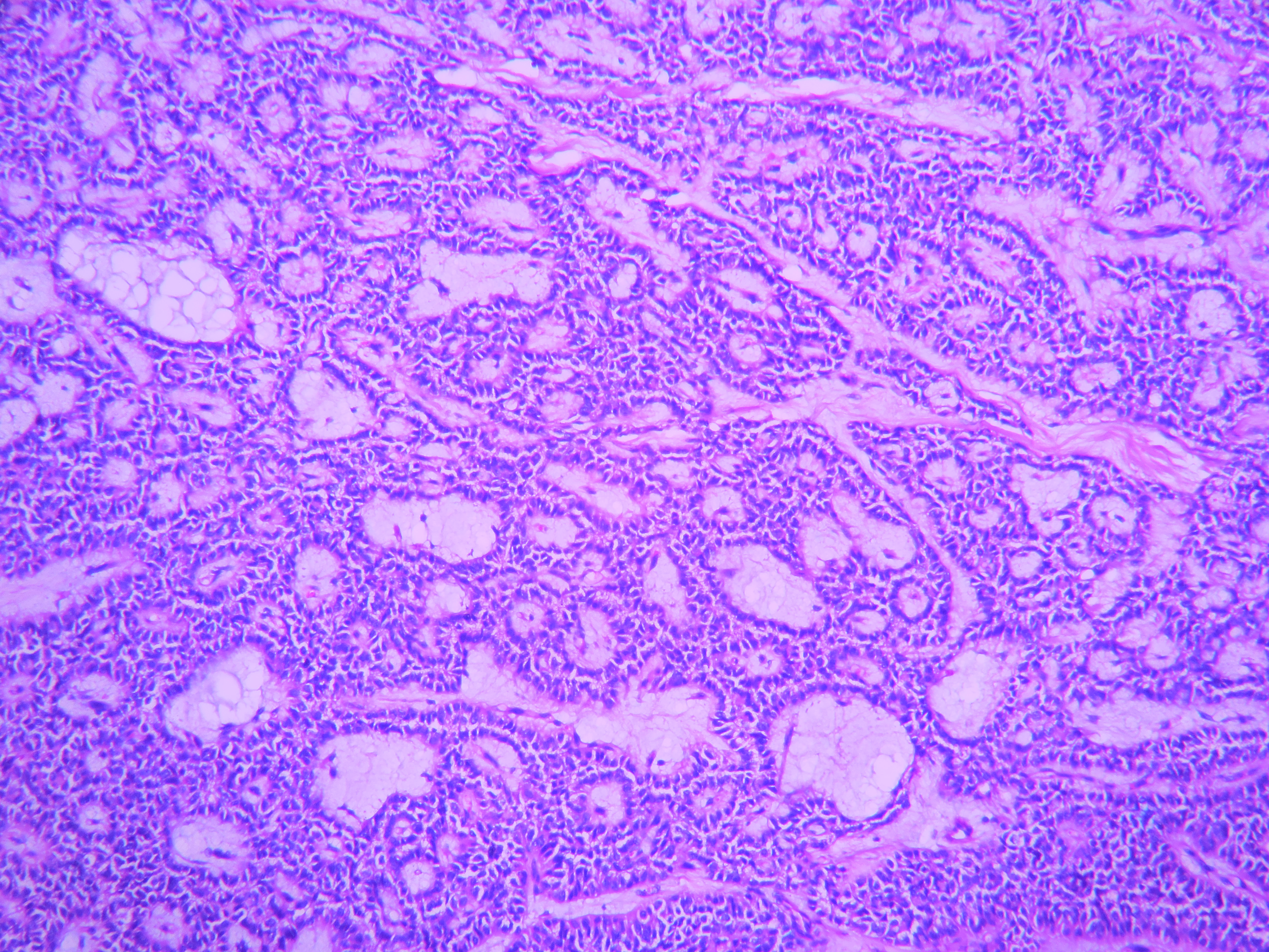 What Is Meant By Histoid Neoplasm