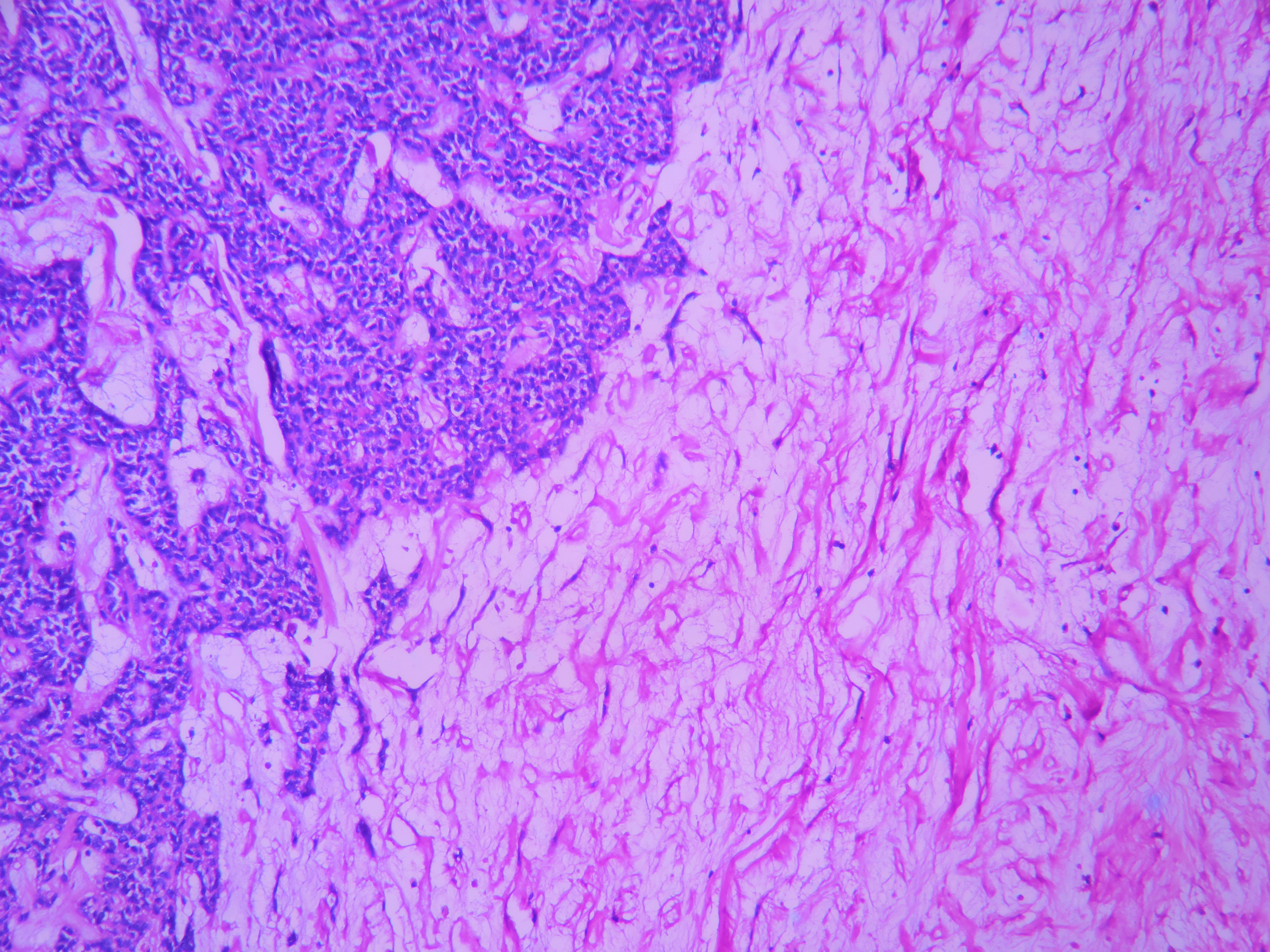 Solid Pseudopapillary Neoplasm Of Pancreas Histopathology Guru