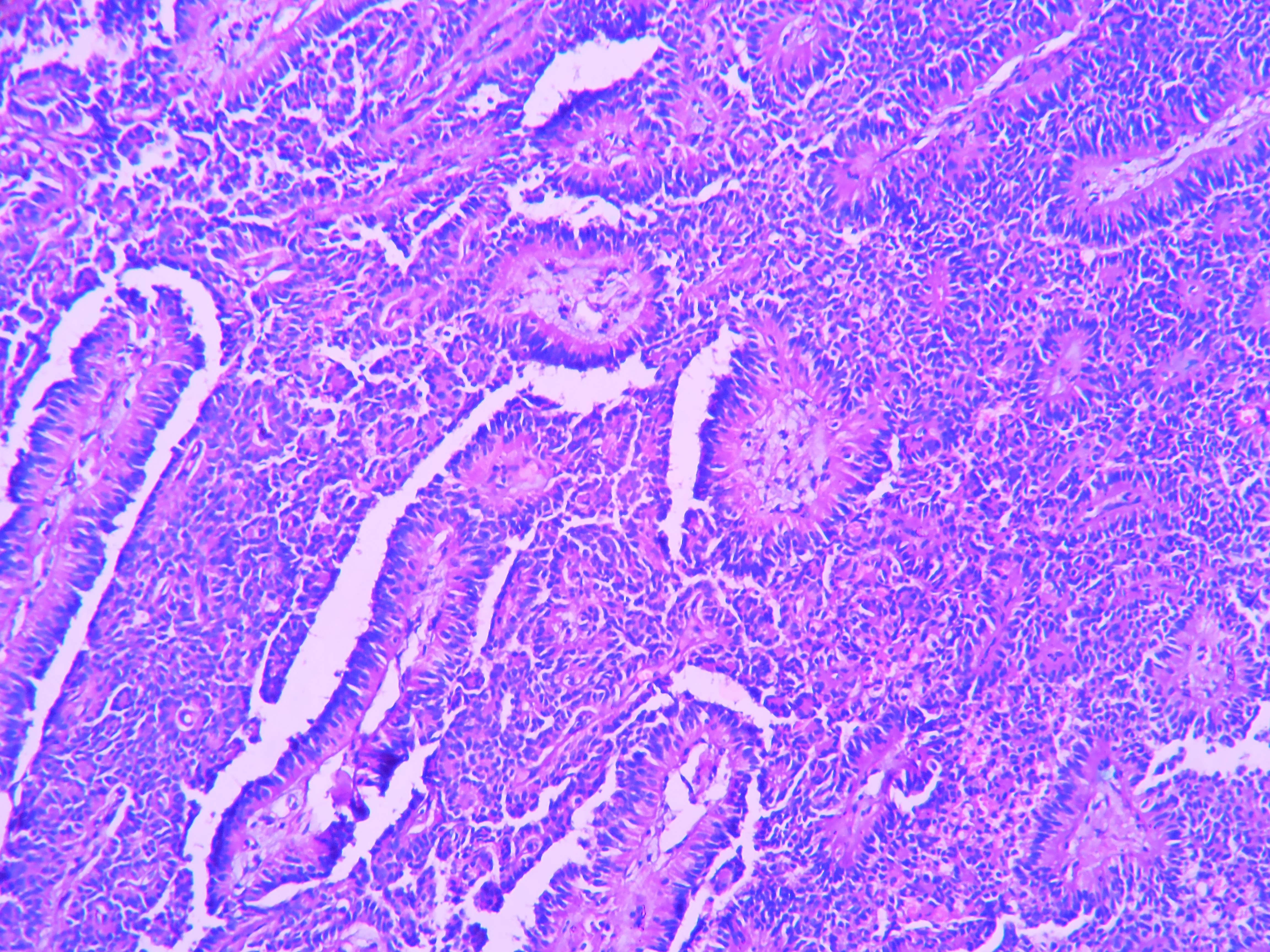 Solid Pseudopapillary Neoplasm Of Pancreas Histopathology Guru