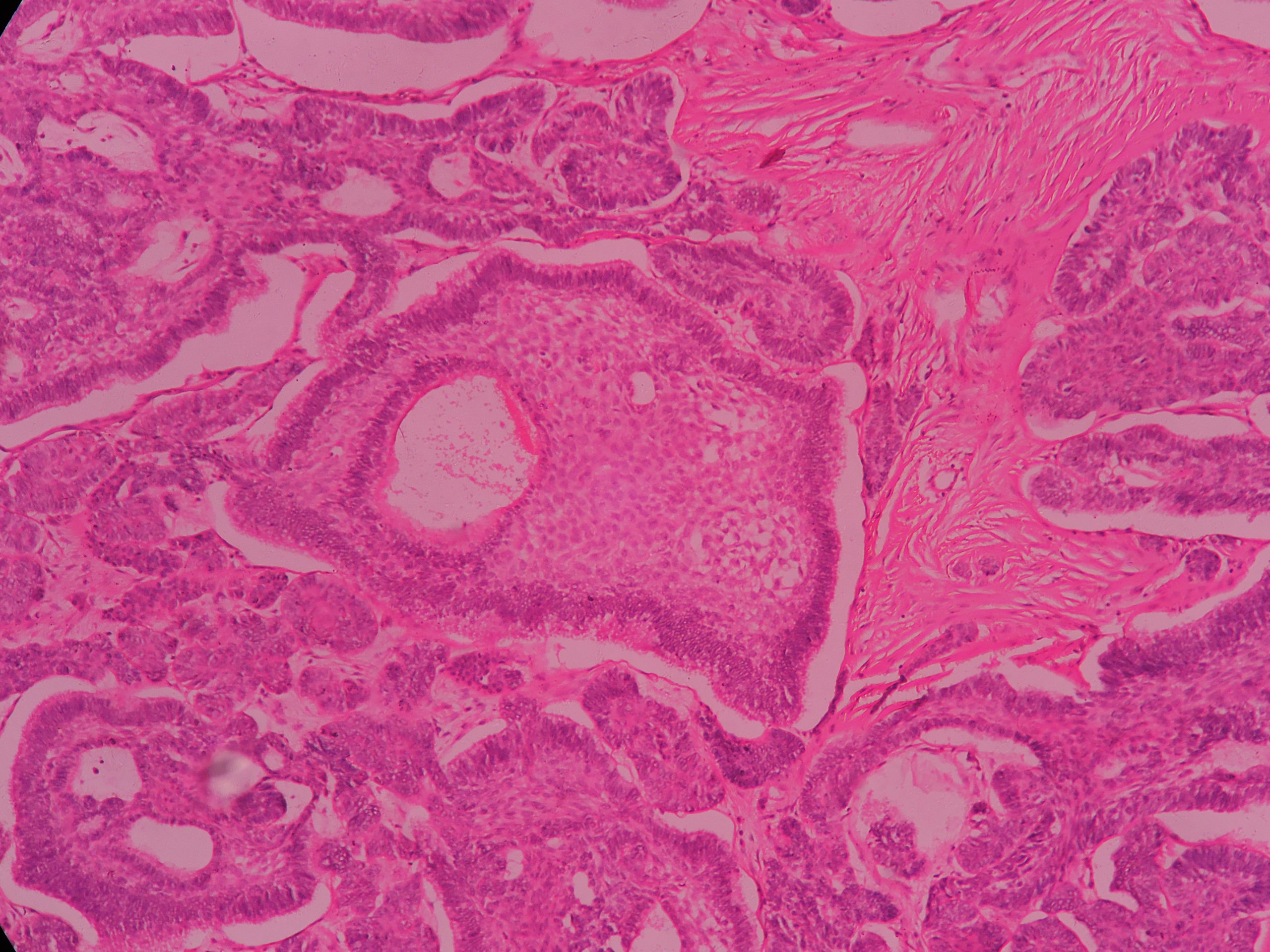 AMELOBLASTOMA Histopathology Guru