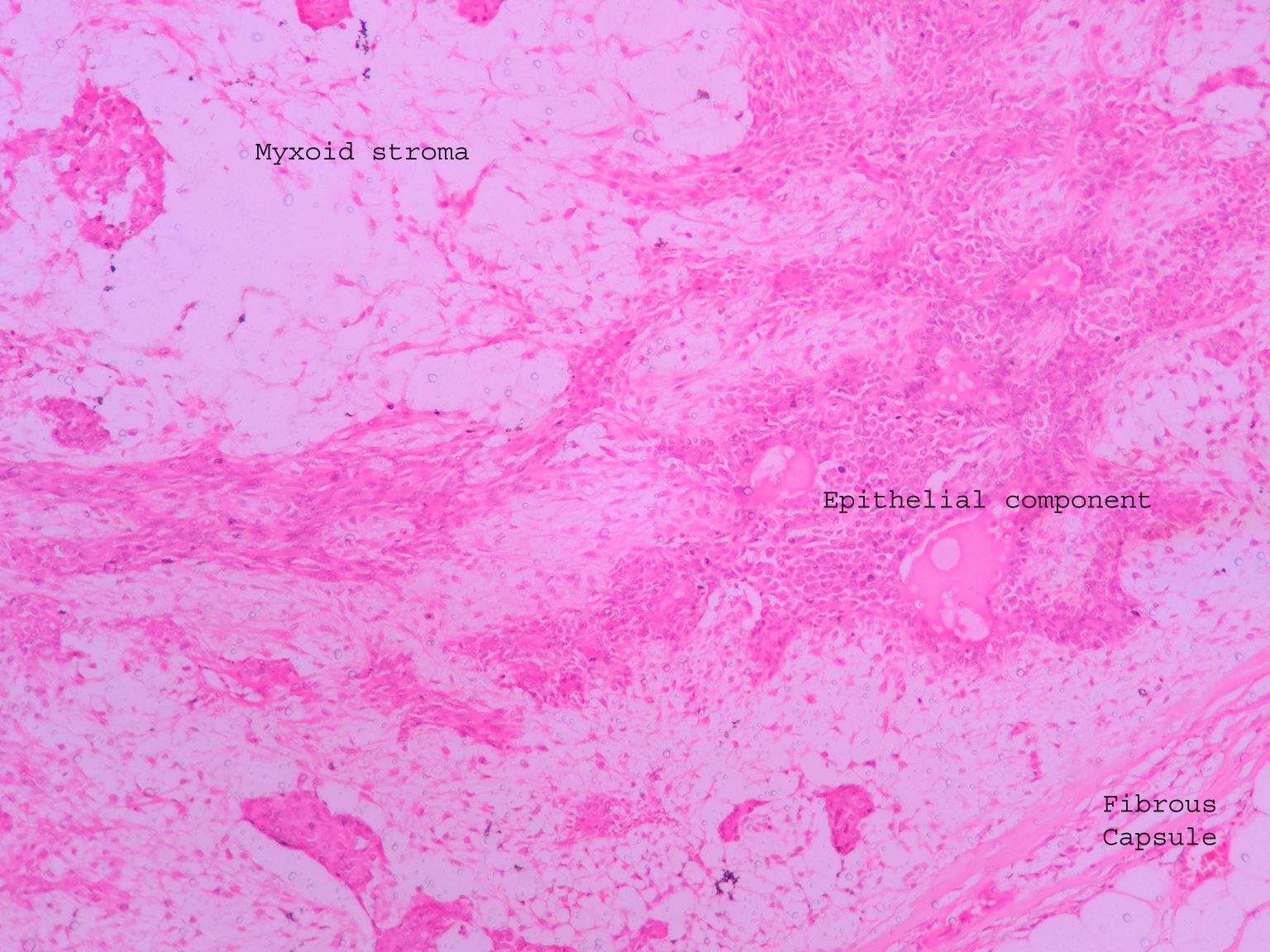 Pleomorphic Adenoma Histopathology Guru