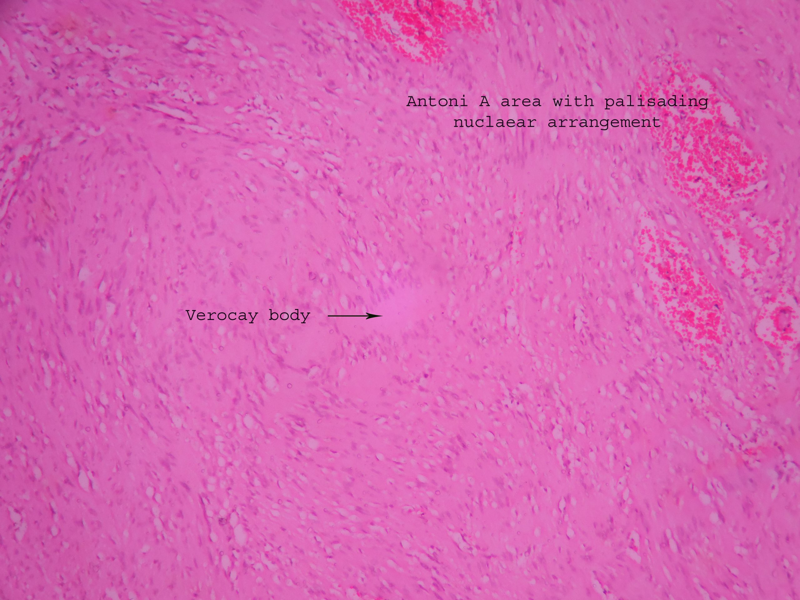 Schwannoma – Histopathology.guru