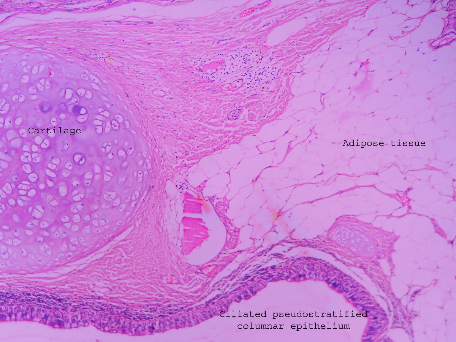 Dermoid Cyst Ovary Histopathology Guru