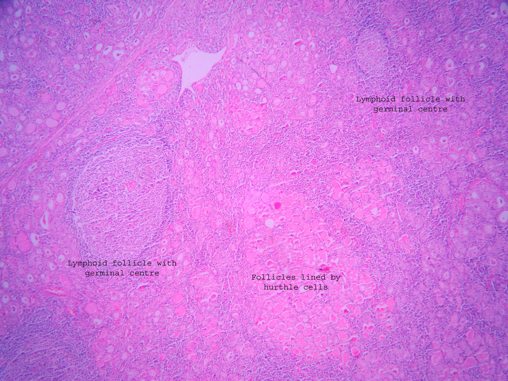 Hashimotos Thyroiditis – Histopathology.guru