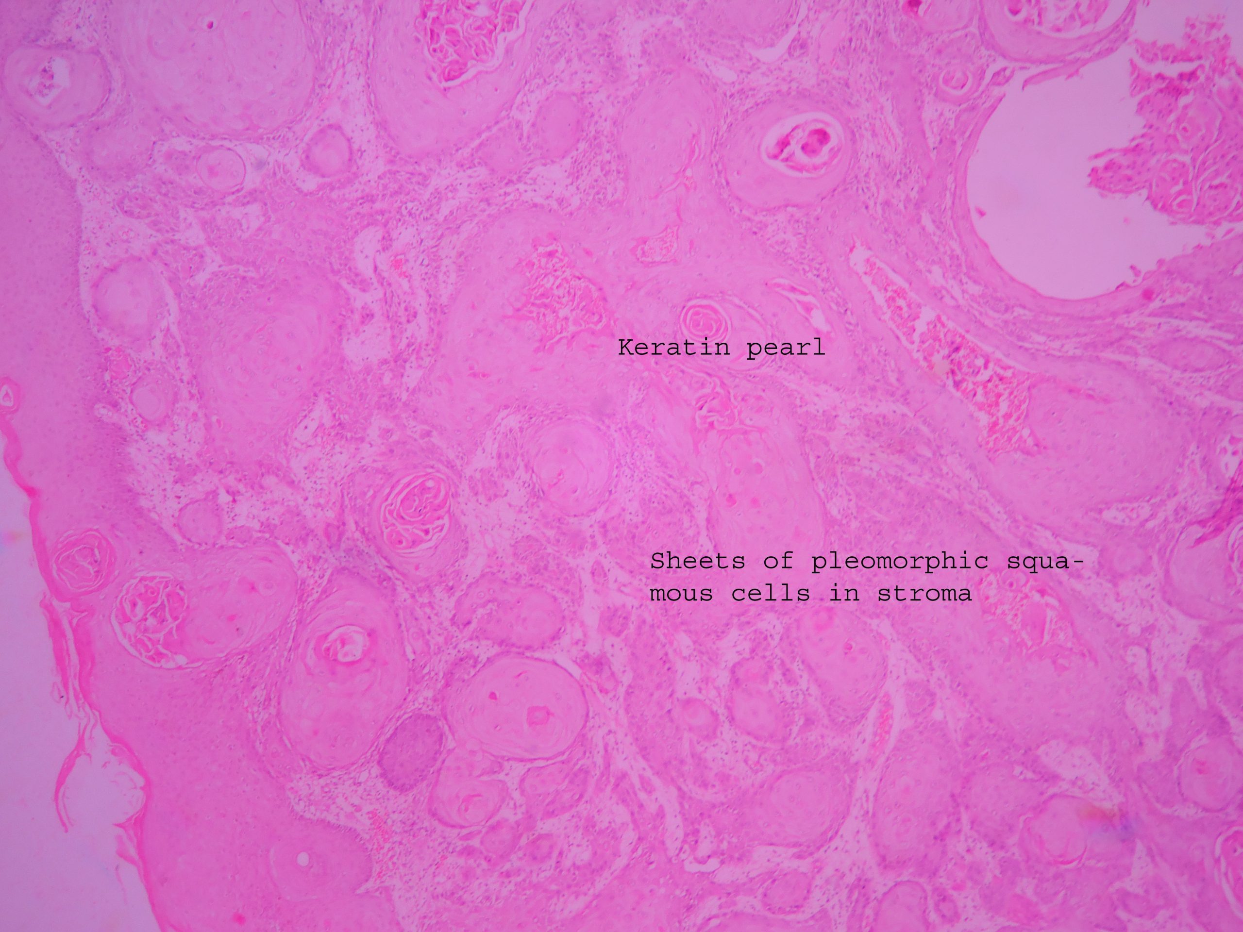 Squamous Cell Carcinoma Histopathologyguru
