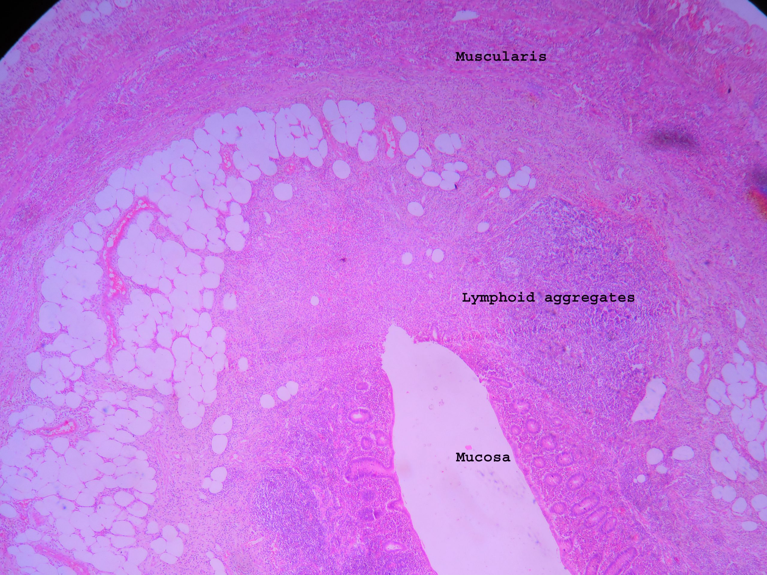 acute-appendicitis-histopathology-guru