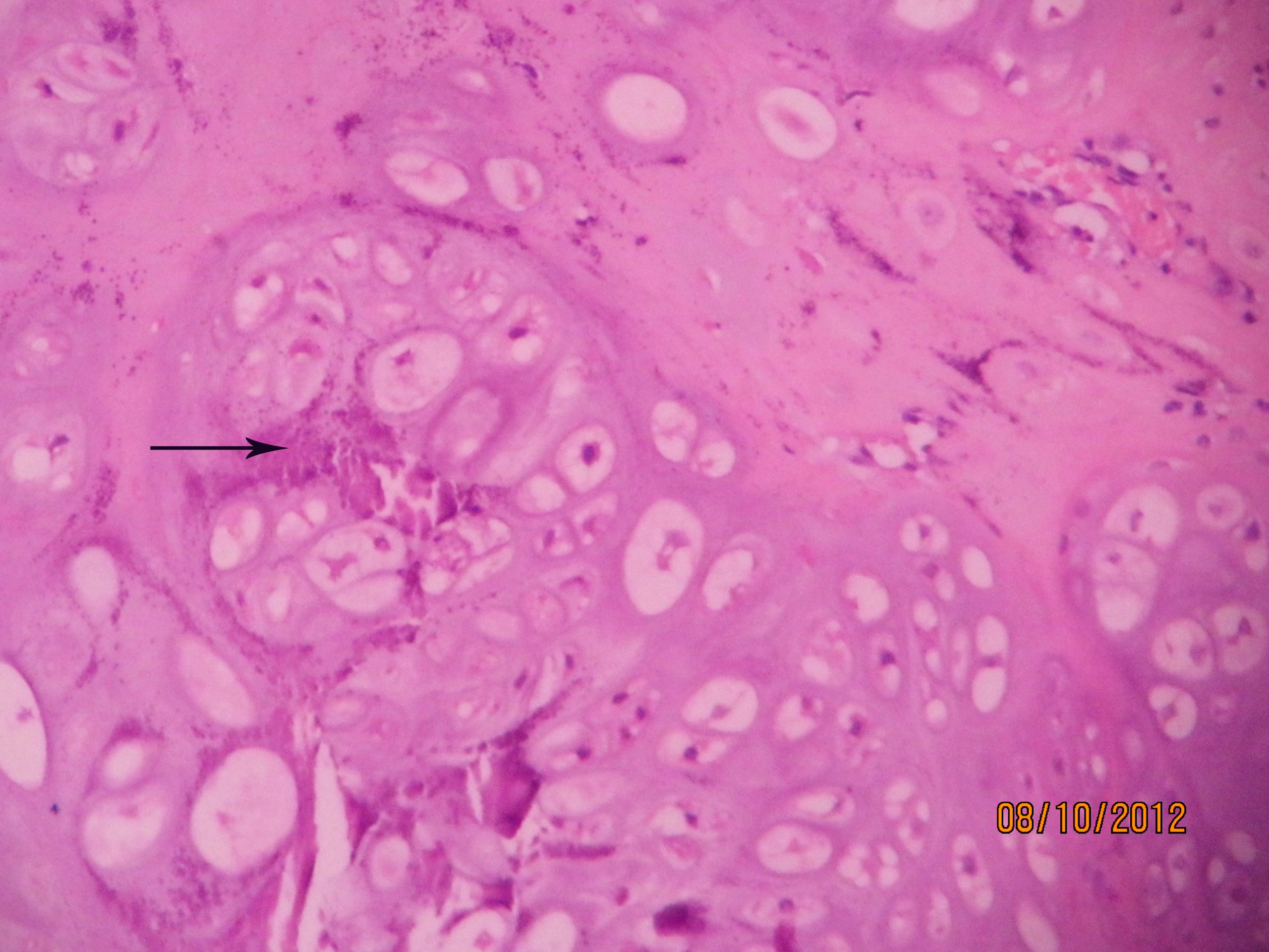 Chondrosarcoma Histopathologyguru 5130