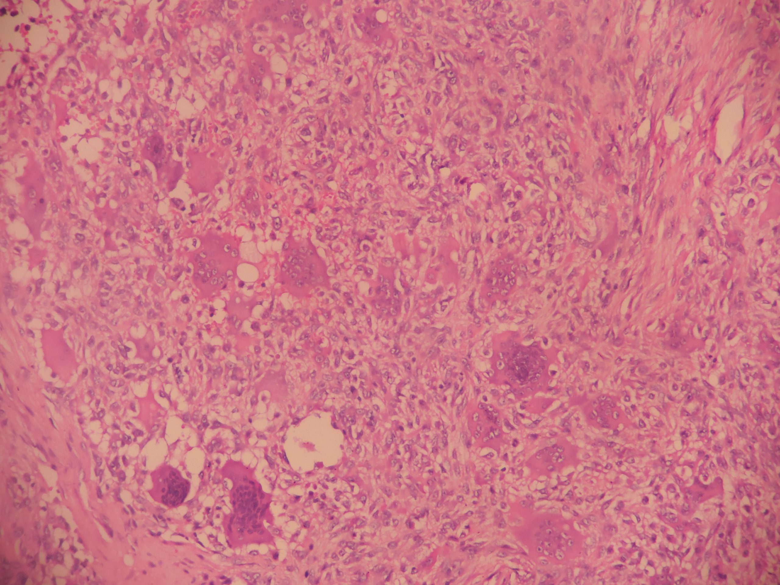 Giant cell tumor of bone Histopathology.guru