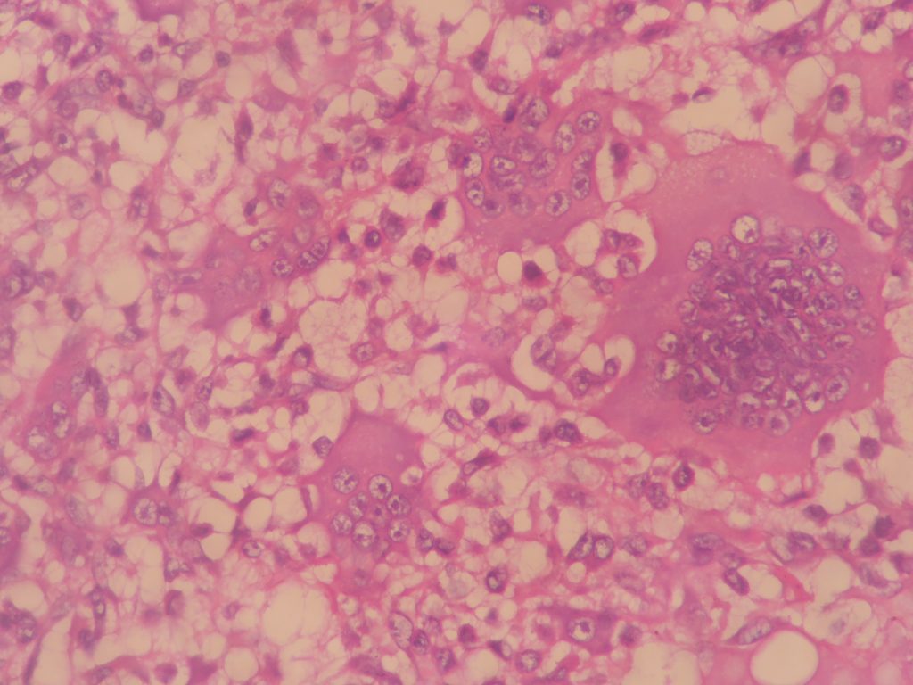 Giant Cell Tumor Of Bone – Histopathology.guru