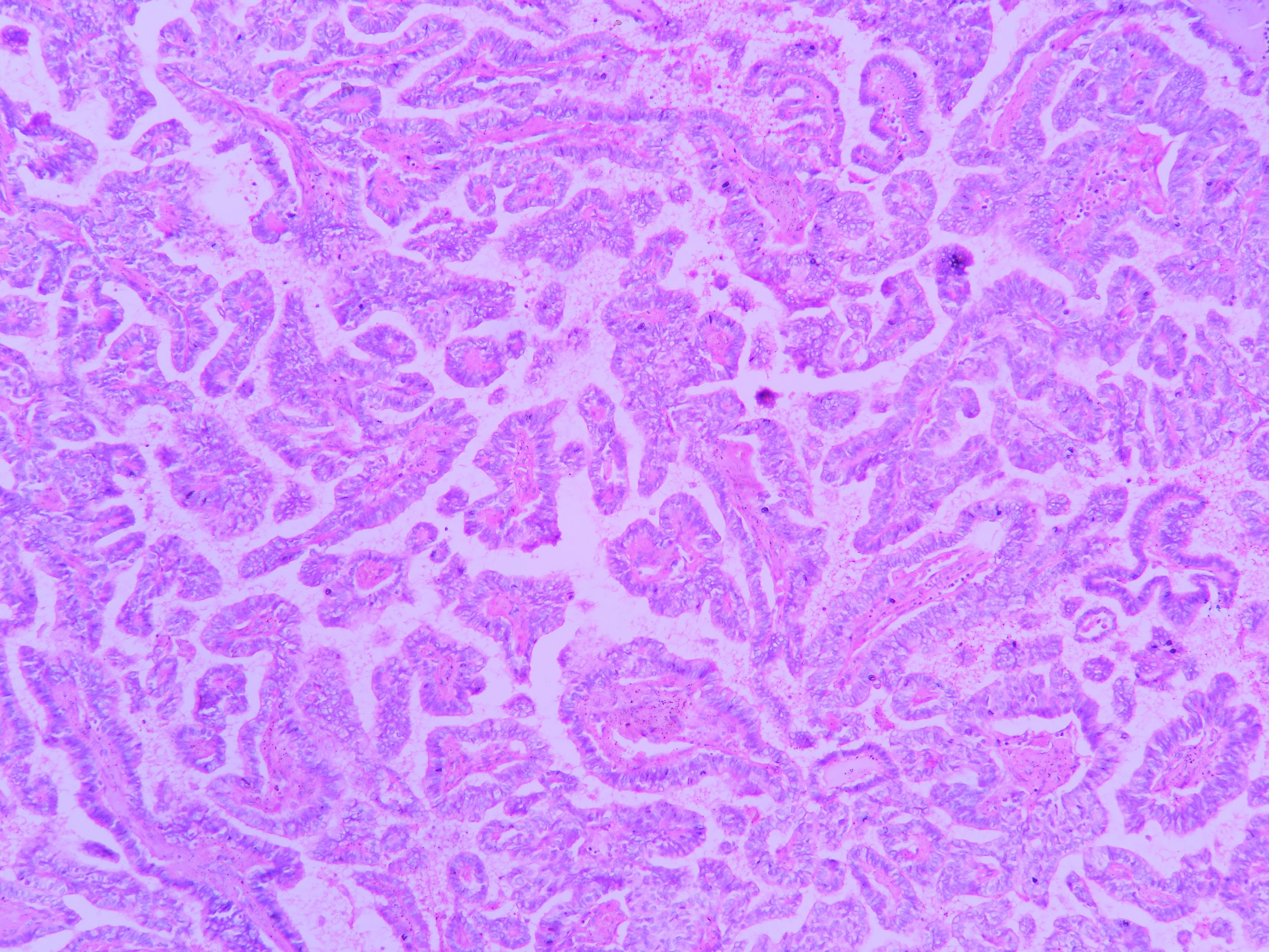 Papillary carcinoma Thyroid Histopathology.guru