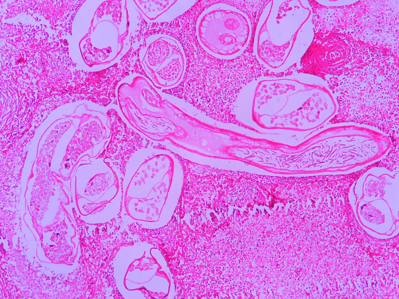 Lymph Node Filaria Histopathology Guru