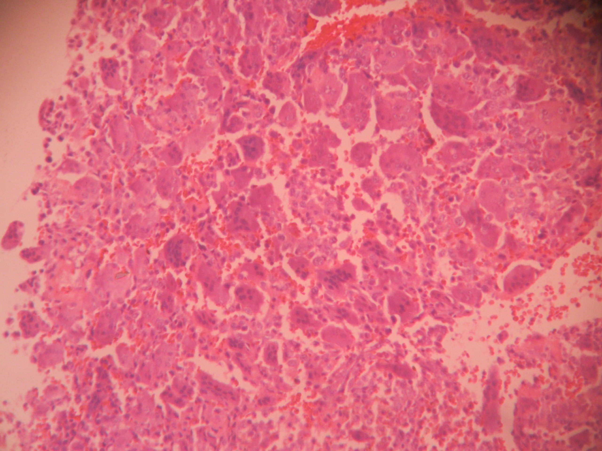 giant-cell-tumor-of-bone-histopathology-guru