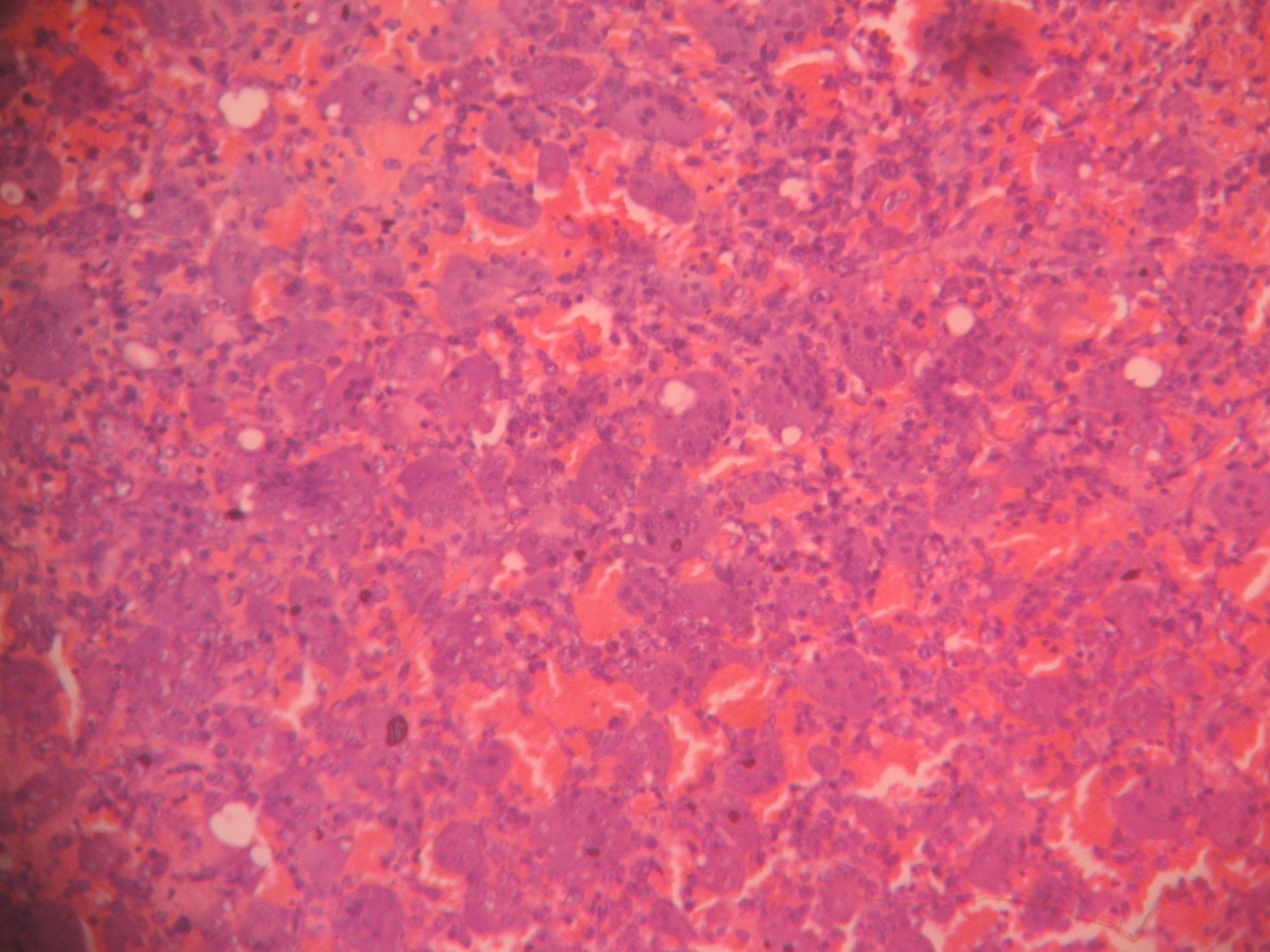 Giant Cell Tumor Of Bone Histopathologyguru