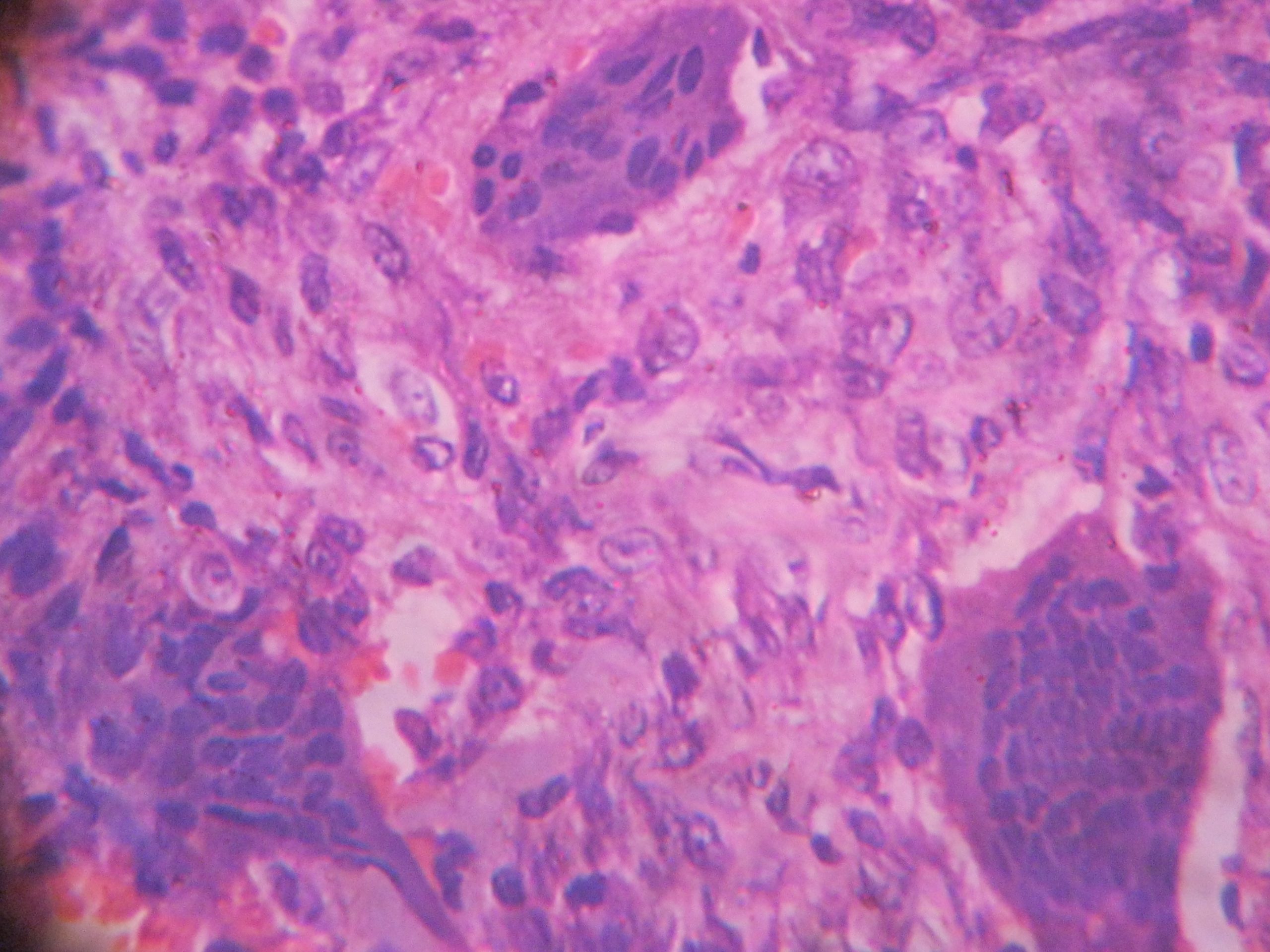 Giant Cell Tumor Of Bone Histopathologyguru