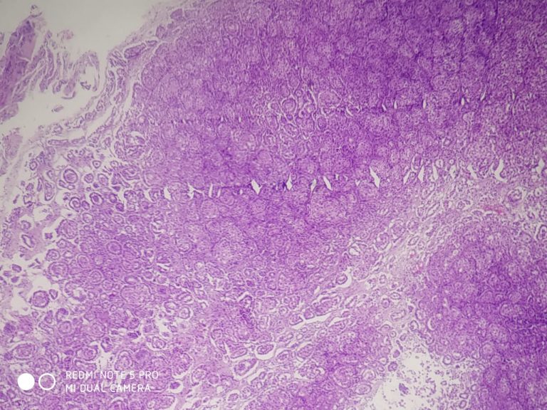 epithelial-malignant-mesothelioma-histopathology-guru