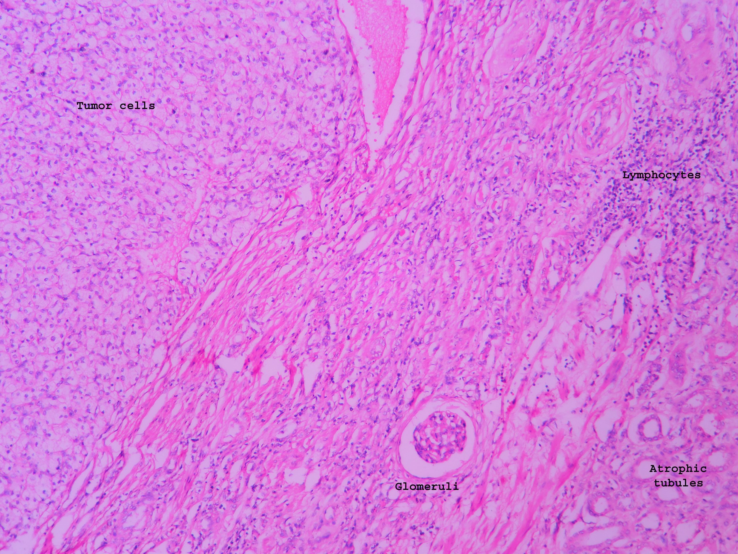 Renal Cell Carcinoma UG Slide Histopathology Guru