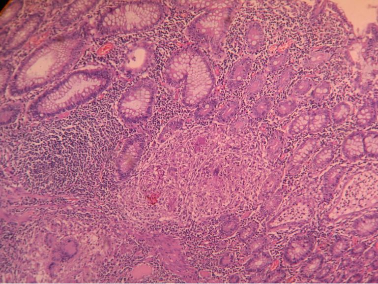 Intestinal Tuberculosis – Histopathology.guru