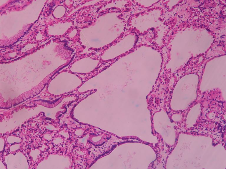 Fundic Gland Polyp – Histopathology.guru