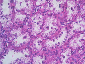 Lactating Adenoma – Histopathology.guru