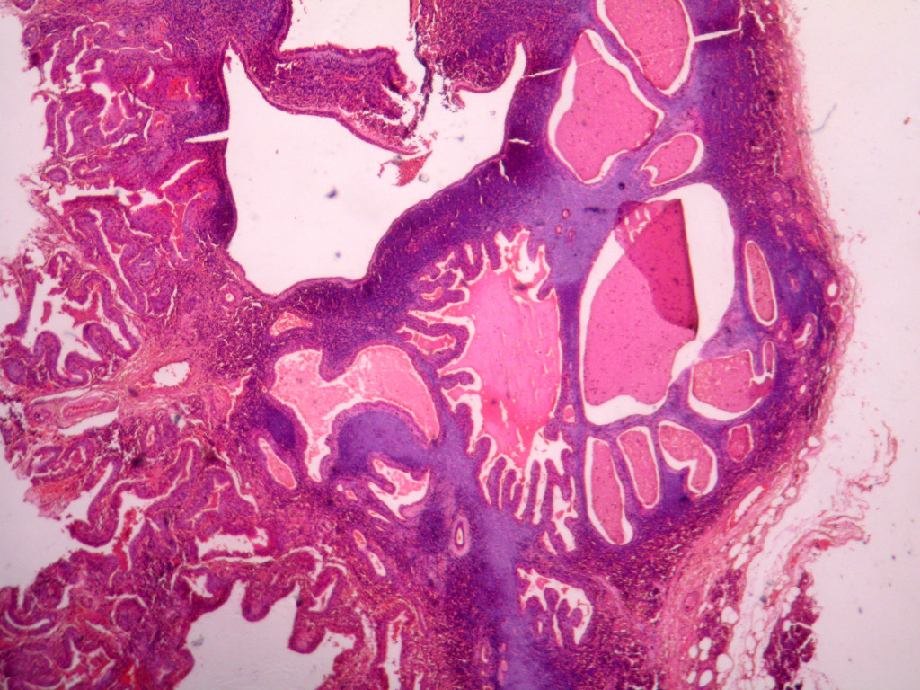 Warthins tumor – Histopathology.guru