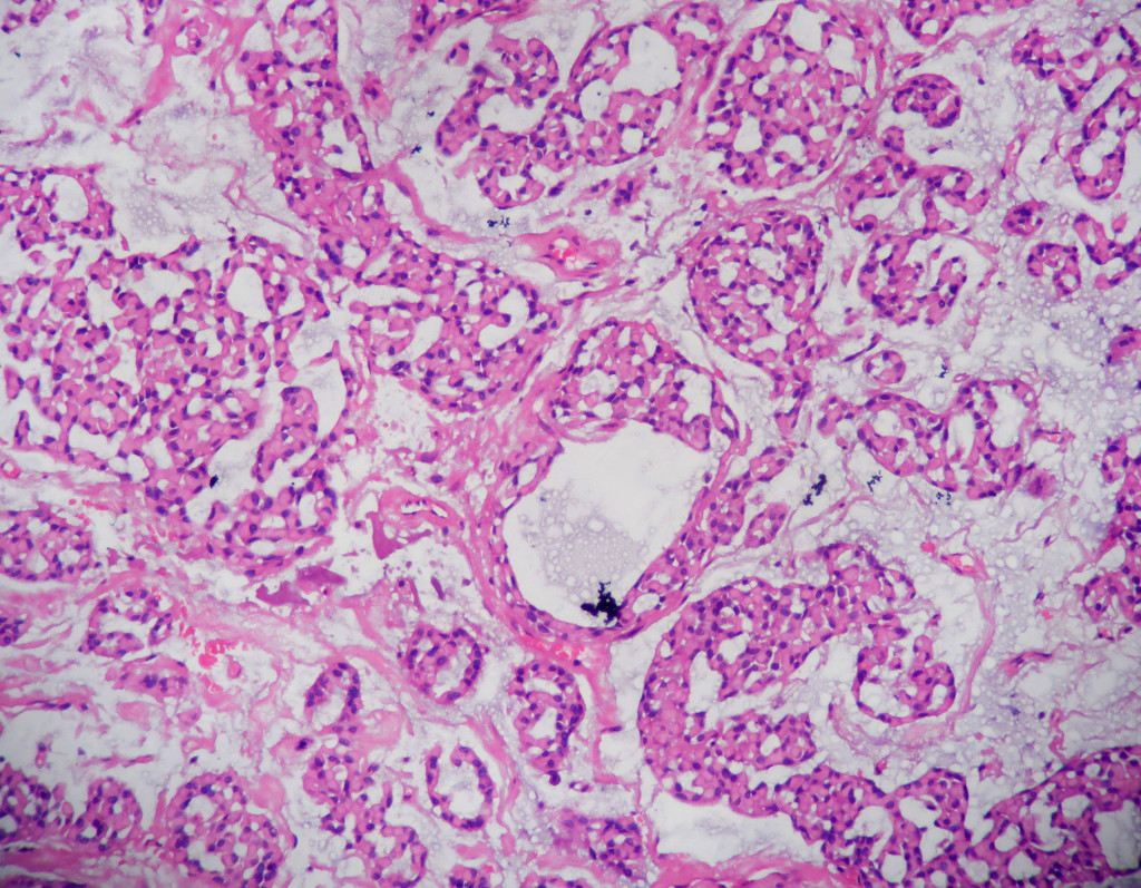 Myoepithelioma – Histopathology.guru