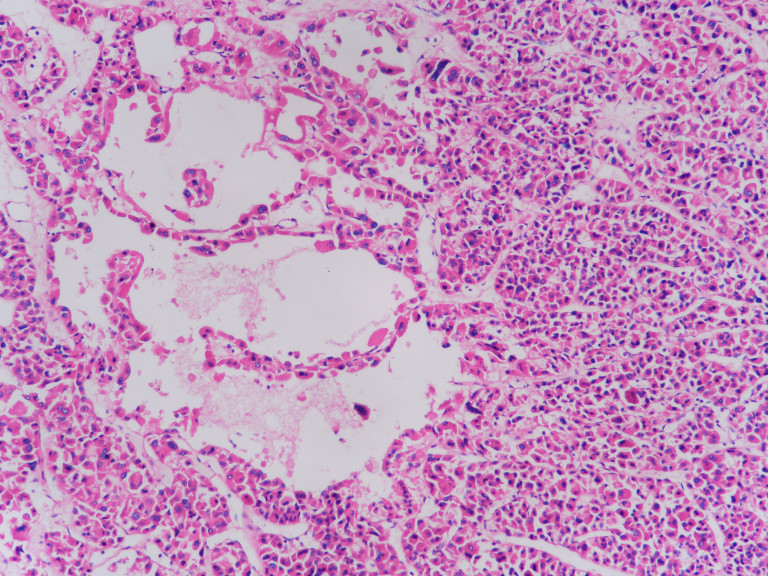 Oncocytoma – Histopathology.guru