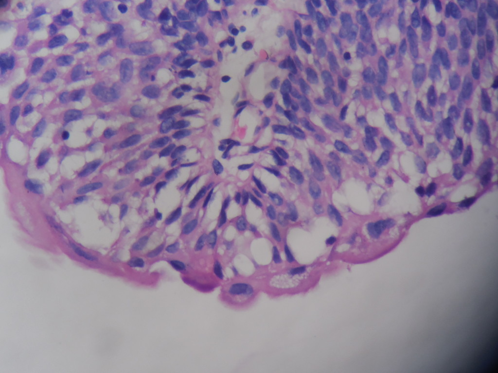 UROTHELIAL PAPILLOMA – Histopathology.guru