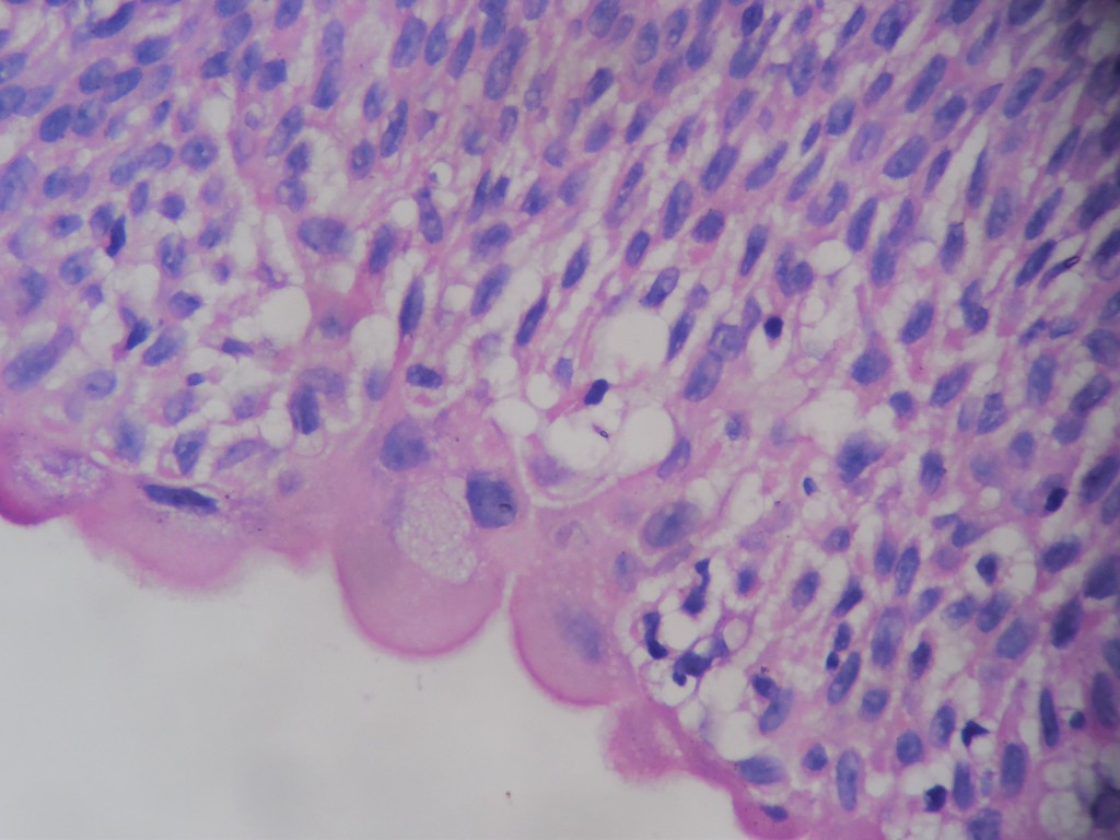 UROTHELIAL PAPILLOMA – Histopathology.guru