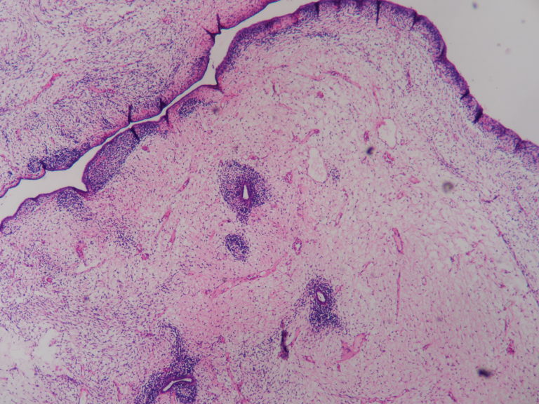 SARCOMA BOTRYOIDES (EMBRYONAL RHABDOMYOSARCOMA ) – CERVIX ...